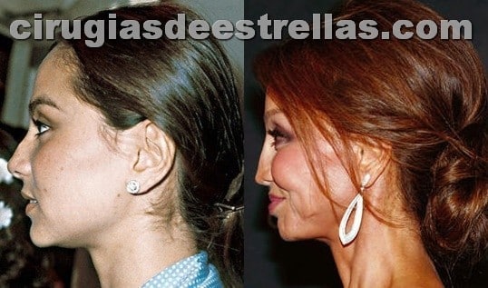 Isabel Preysler: Su evolución facial a golpe de bisturí y operaciones de cirugía estética